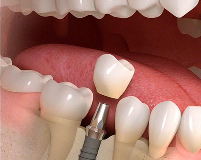Установка имплантов и протезов зубов