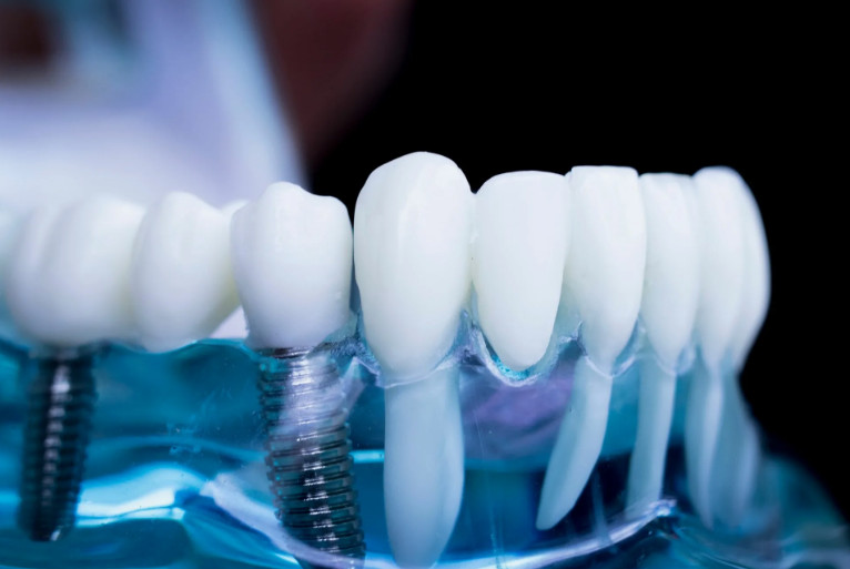 Современная стоматология и имплантация